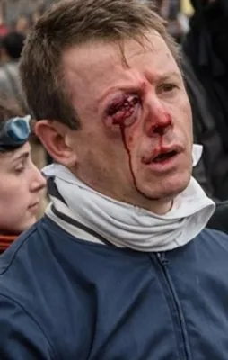 Polis şiddeti nedeniyle gözünü kaybetti