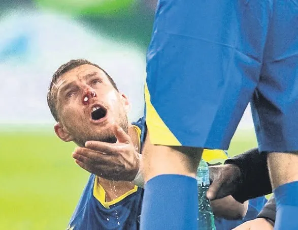 Dzeko’nun burnu kırıldı