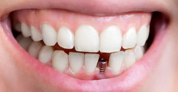 Implant Tedavisi Yuz Guldurur Takvim