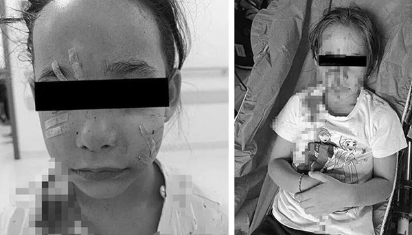 esenyurtta-basibos-kopek-cocugun-yuzunu-parcaladi-istanbul-valiliginden-kuduz-haberlerine-iliskin-aciklama-gel-1695324882241.jpeg Esenyurt'ta başıboş köpek çocuğun yüzünü parçaladı! İstanbul Valiliğinden 'kuduz' haberlerine ilişkin açıklama geldi: Gerçeği yansıtmamaktadır-2