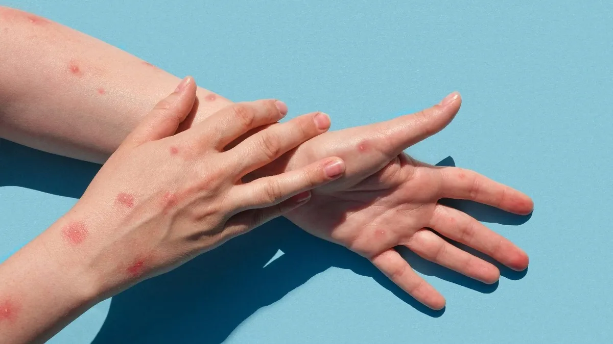 Maymun Çiçeği alarmı sonrasında herkes bunu araştırıyor! Çiçek aşısı nedir? Çiçek aşısı Türkiye'de yapılıyor mu? İşte çiçek aşısı ve Osmanlı...