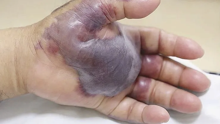  Deniz ürünlerine dikkat! Çiğ yedi elinden oldu!  - 1