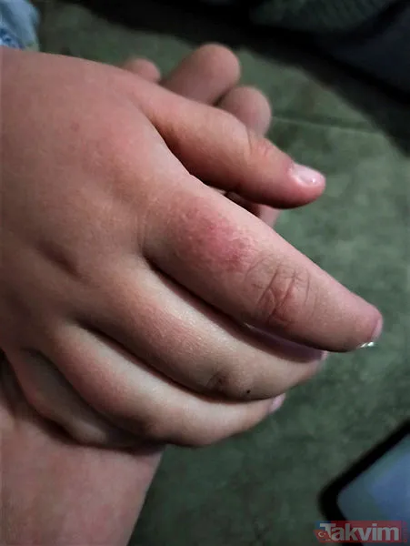 Antalya'da bir babanın iddiaları duyanları şoke etti! Parmaklarında yanık izleri, bileklerinde morluk... - 7