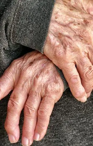 En çok 40 ve 50'li yaşlarda görüldüğünü! Romatoid artrit ağrının yanı sıra ellerin garip şekillere girmesine de sebep oluyor