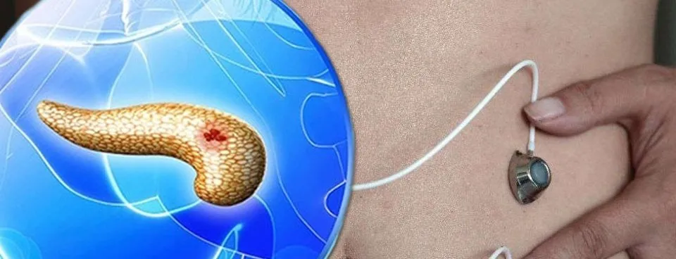 pankreas kanseri nedir pankreas