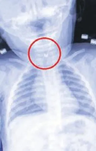 Tekirdağ'da 7 aylık bebeğin yemek borusuna çengelli iğne kaçtı