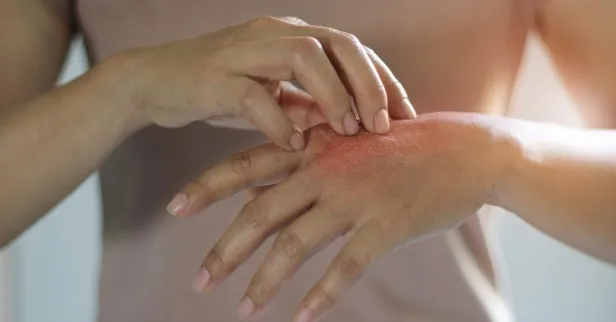 Bilim insanları ilk kez açıkladı: Koronavirüs 5 farklı cilt hastalığına sebep oluyor!-4
