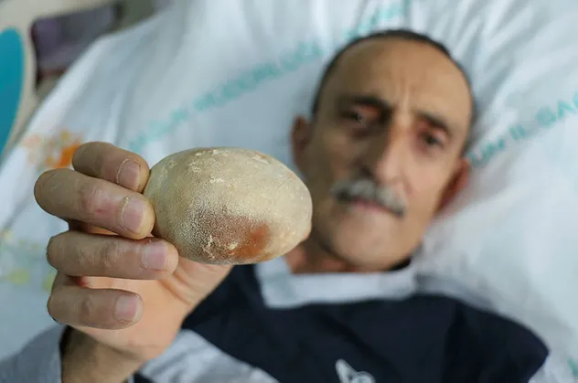 Samsun'da doktorları şoke eden olay: Görünce patates sandım