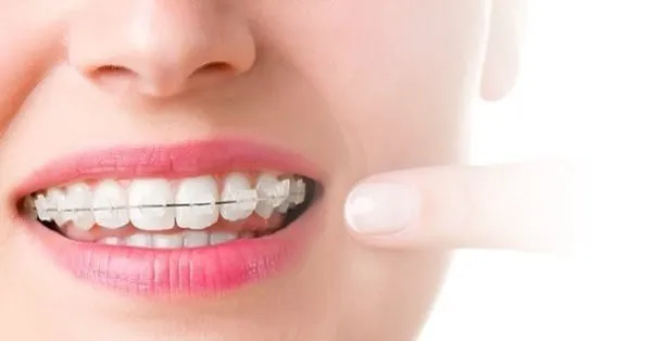 Dis Telleri Neden Takilir Ve Ne Kadar Sure Takili Kalir Cesitleri Nelerdir Iste Dis Telleri Tedavisi Hakkinda Merak Edilenler Takvim