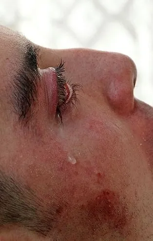 Subakut Sklerozan Panensefalit hastası Halil Özçelik 5 yıldır gözlerini kırpamıyor