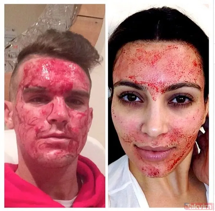 Kim Kardashian’a özenmişlerdi: Vampir botoksu sonları oldu! Uzmanlardan uyarı: Yaptıran HIV’e yakalanıyor