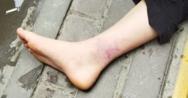 Kastamonu’da köpeklerin havlamasından korkan 12 yaşındaki çocuk kaçarken otomobil ayağını ezdi