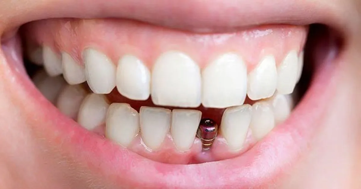 Implant Tedavisi Yuz Guldurur Takvim