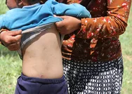 Sivasta ormanlık alanları istila eden tırtıllar yüzünden günde 10 kişi hastaneye gidiyor!