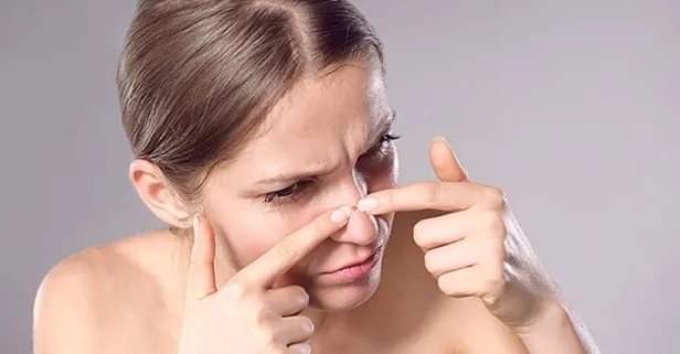 Her 5 kadından birinin yaptığı akneye yol açan 7 hatalı alışkanlık