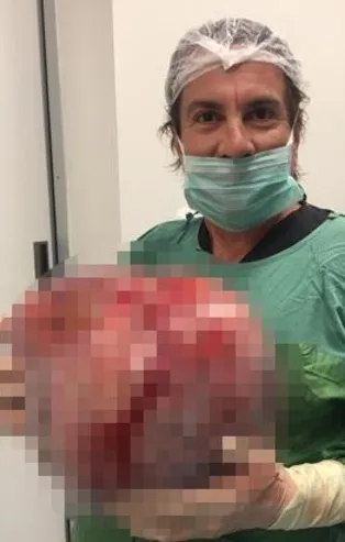 Kilo aldığını sanan yaşlı kadının karnından 12 kilogram ağırlığında yumurtalık kisti çıkartıldı