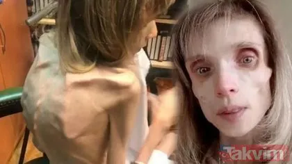 Rus spiker Kristina Karyagina 4 yaşındaki çocukla aynı kiloda! Anoreksiya nedir?