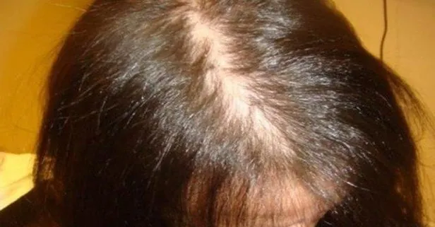 Aşırı fön saç döküyor: Saça ısı veren işlemlerden kaçının