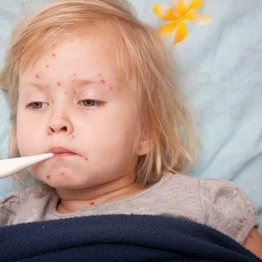 Kızamığı erkenden önleyin