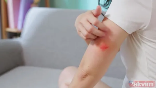 Lyme Hastalığı Belirtileri Neler? Kene Isırmasından 3–30 Gün Sonra Lyme Hastalığı Belirtileri Ortaya Çıkabilir. Hastalarda Yorgunluk, Titreme, Ateş, Baş Ağrısı,...