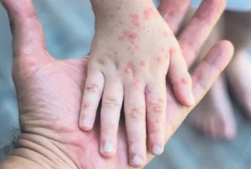 Bu virüs çocuklarda hızla bulaşıyor