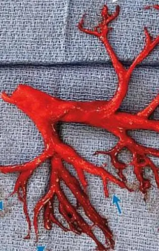 Akciğerini öksürdü, hayatını kaybetti