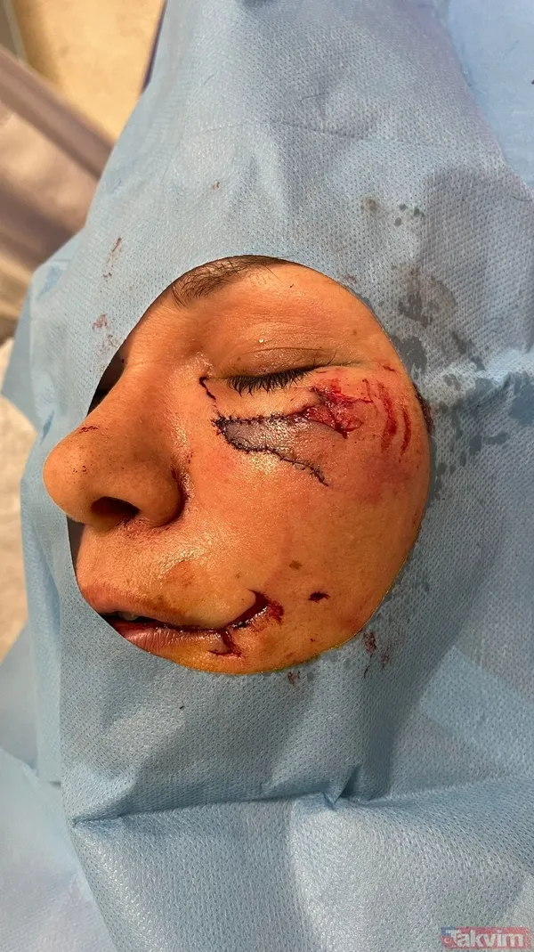 Tuğba Altıntop köpek saldırısına uğradı! Yüzüne dikiş atılan Tuğba Altıntop'un son hali yürek sızlattı - 6