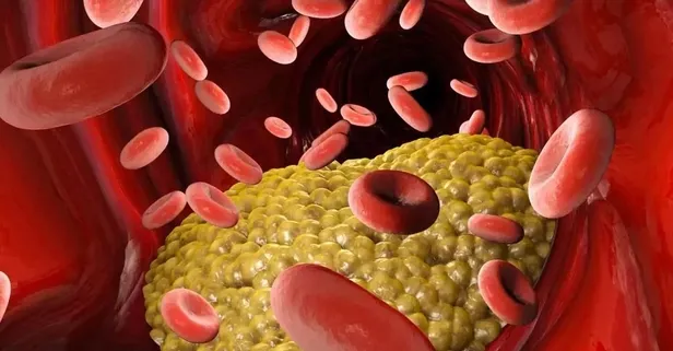 Kolesterol sessiz ilerliyor: Halsizlik ve ciltte sarı lekelere dikkat!