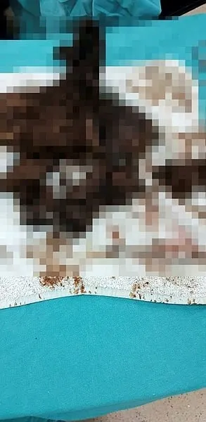 Kayseri'de bir hastanın midesinden tam 700 gram kıl çıktı!-1