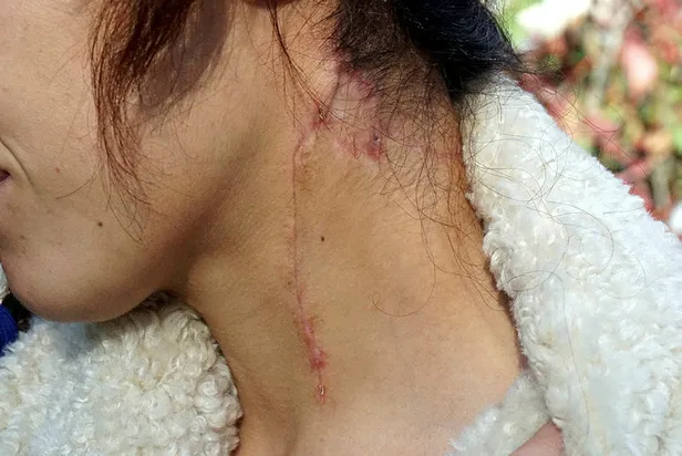 Antalya'da eski eş vahşetinden kurtulan Oya Aydoğdu: Aklıma Emine Bulut geldi-1