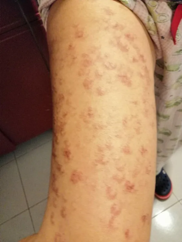 lazer-epilasyon-icin-guzellik-merkezine-gitti-vucudunda-1-derece-yaniklar-olustu-1617716796679.jpg Lazer epilasyon için güzellik merkezine gitti! Vücudunda 1. derece yanıklar oluştu-9