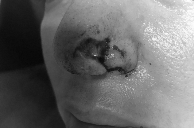 Yürüyüş yaparken pitbull saldırısına uğradı! Burnu parçalandı