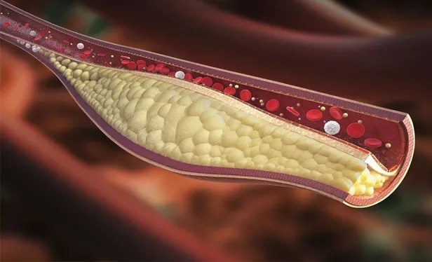 damar-tikanikligi-50-yasini-bekliyor-uzmanlar-kolesterolun-yol-actigi-tehlikeler-icin-uyariyor-1653940609521.jpeg Damar tıkanıklığı 50 yaşını bekliyor! Uzmanlar kolesterolün yol açtığı tehlikeler için uyarıyor-6