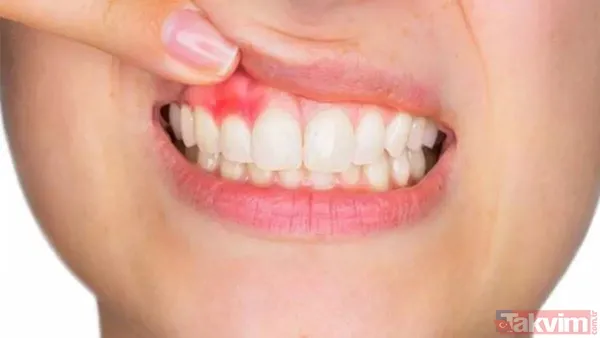 Bu belirtiler sizde de varsa dikkat! Yüzünüz hangi vitamin eksikliğiniz olduğunu söylüyor! - 4