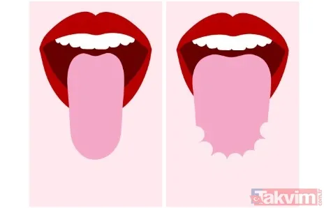 🟡 Dil Üzerindeki Tabaka Ne Anlatıyor? Kalın Beyaz Tabaka: Dolaşım Sorunları Veya Maya Enfeksiyonu Olabilir. Sarı Tabaka: Vücutta Enfeksiyonun Varlığına İşaret...