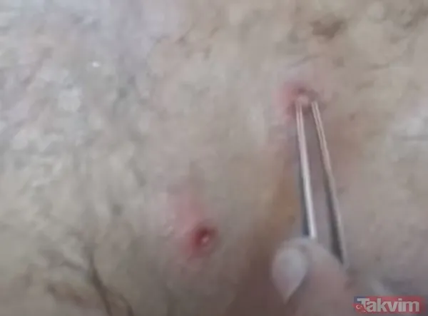 Karnındaki şişlik için gitti içinden çıkan doktorları bile şoke etti! Yer uzak değil Kayseri! 64 kilo girdi 55 kilo çıktı - 26