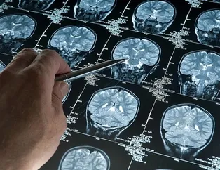 Alzheimer hapı yuttu