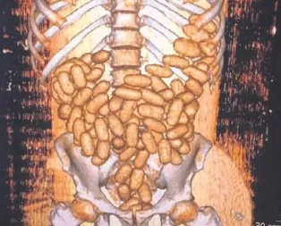 Midede kapsül kapsül eroin