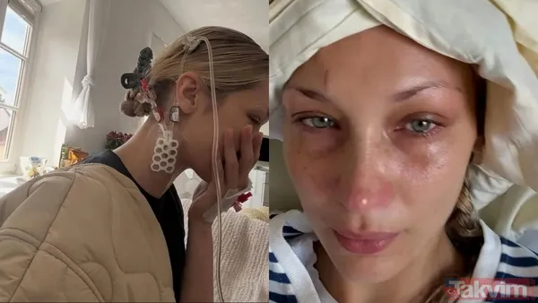 İnsan Enfeksiyonlarının Çoğu Olgunlaşmamış Keneler Aracılığıyla Gerçekleşir; Çünkü Bu Keneler 2 Mm'den Küçük Olduklarından Vücutta Fark Edilmeleri Zordur...