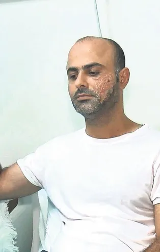 Yanağındaki kılları aldırmak için epilasyona gitti hayatı karardı!