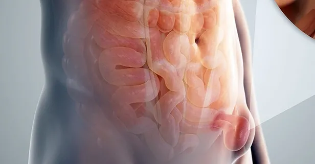 Kasık fıtığı kimlerde daha sık görülüyor? Uzun süre ayakta kalanlar dikkat!