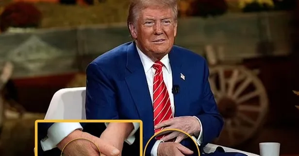 Elindeki morlukların sebebi 25 yıllık alışkanlığıymış! Donald Trump ilk kez açıkladı