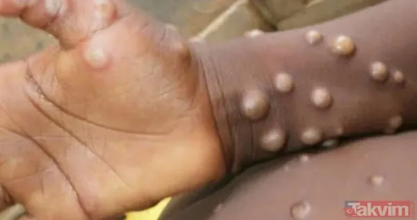 Maymun çiçeği yayılıyor! 'Cinsel yolla bulaşıyor' iddiası... Fetiş festivaliyle başladı! - 8