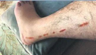 1654982434501.jpeg Acemi hemşire hastasının bacağındaki alçıyı çıkarırken ayağını kesti!-2