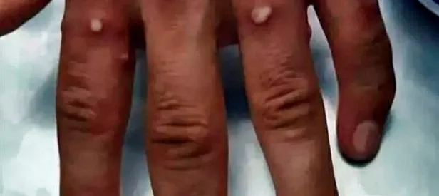 Komşuda ilk maymun çiçeği vakası