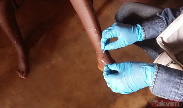 Maymun çiçeği aşısı ve kapanma olacak mı? Maymun çiçeğinin kaç türü var? İşte çocukları bulan türü! DSÖ'den resmi açıklama - 14