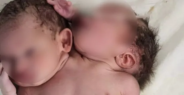 Doktorlar gözlerine inanamadı! Çift başlı üç elli bebek doğdu