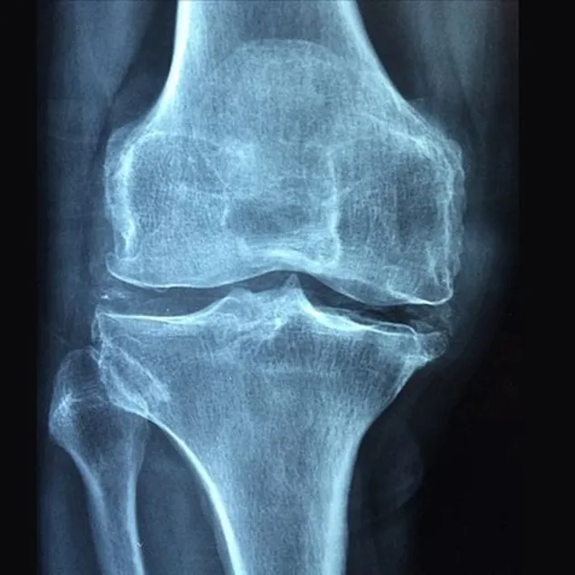 Kemik erimesi ailenizin eseri