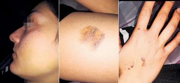 Yeni evli genç kadın 2 ayda cehennemi yaşadı: Dehşetin izlerini vücudunda taşıyor!-2