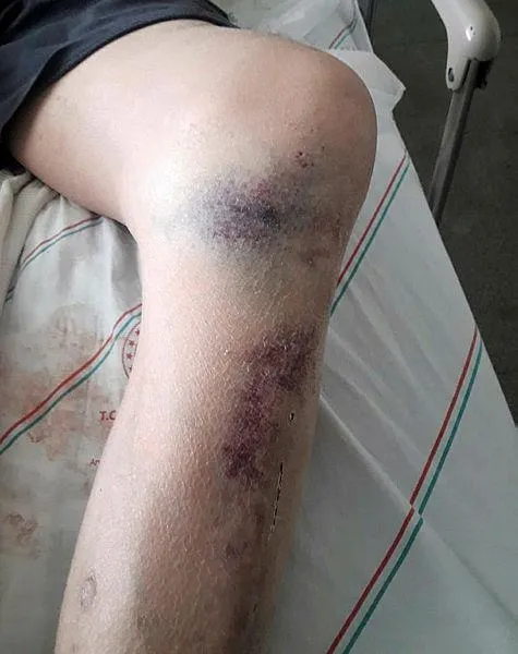 antalyada-darbedilen-yuzde-90-engelli-mumun-kara-hayatini-kaybetti-2-tutuklama-1614550725056.jpeg Antalya'da darbedilen yüzde 90 engelli Mümün Kara hayatını kaybetti! 2 tutuklama...-5